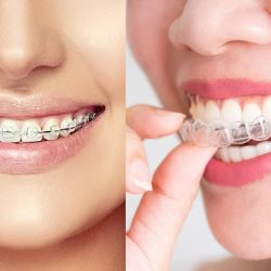 Orthodontics ( clear braces/invisiline/aligners)